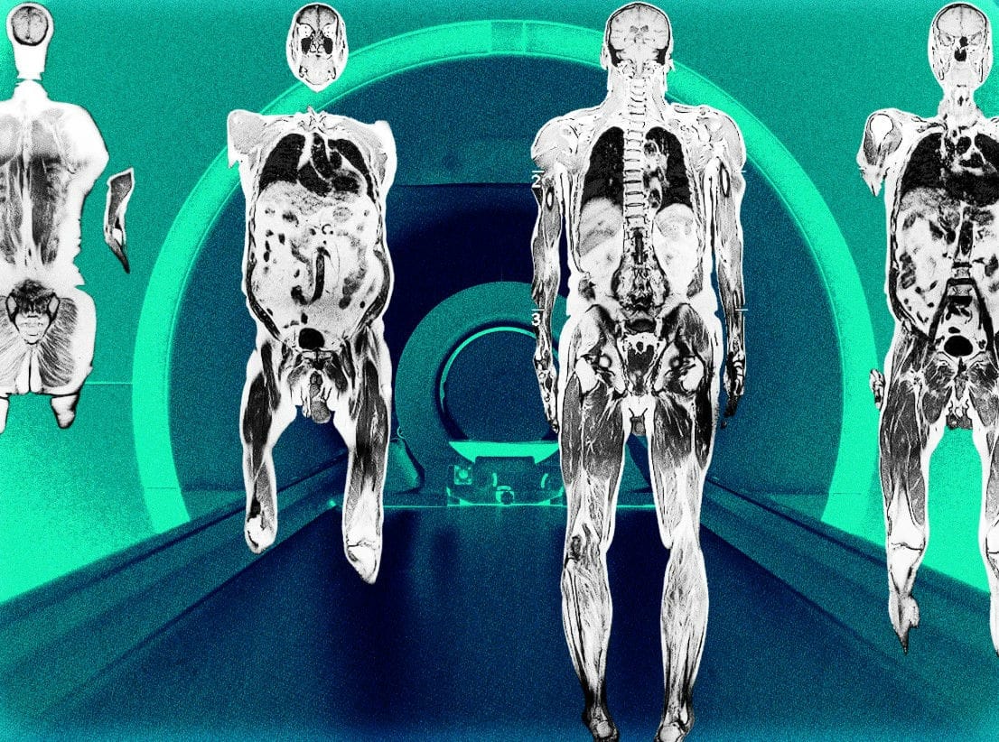 Trend Report: Full Body MRI Scan